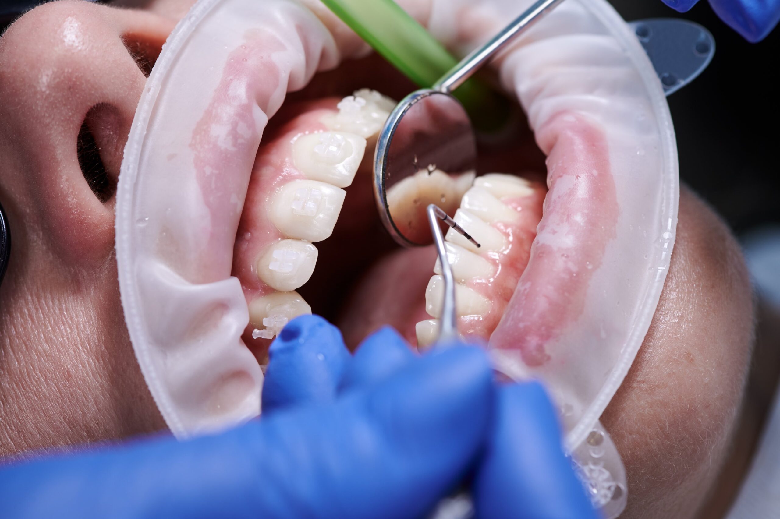 odbudowa zęba Chorzów